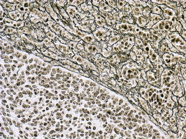 1D3 Medulloblastoma, Desmoplastic (Case 1) Retic 4