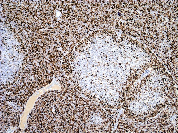 1E1 Medulloblastoma, Desmoplastic (Case 1) MIB 6