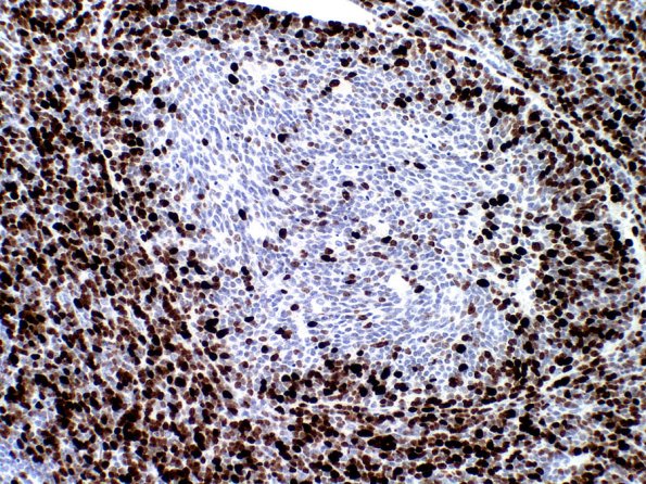 1E2 Medulloblastoma, Desmoplastic (Case 1) MIB 1