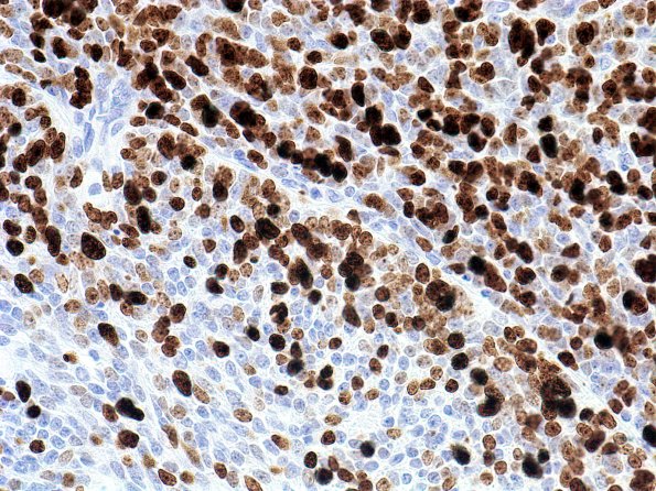 1E3 Medulloblastoma, Desmoplastic (Case 1) MIB 5