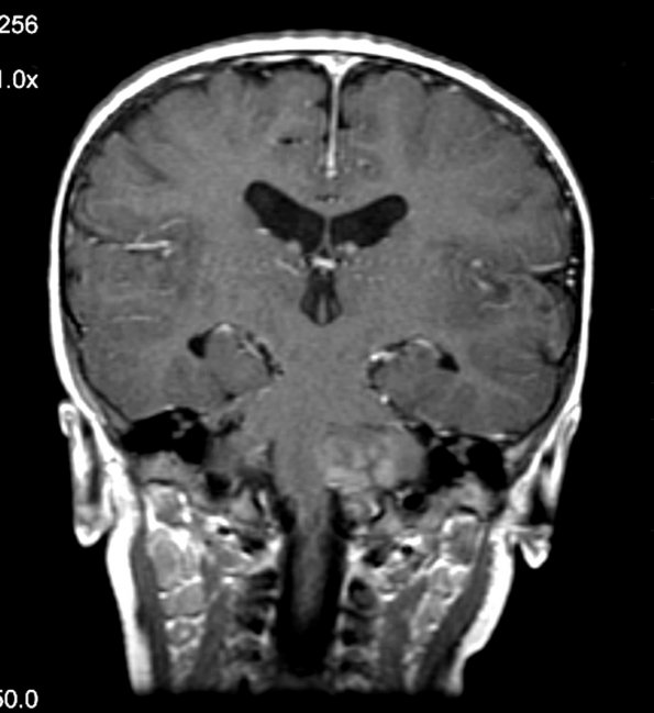 1A2 Medulloblastoma, extensively nodular (Case 1) MRI 1 - Copy