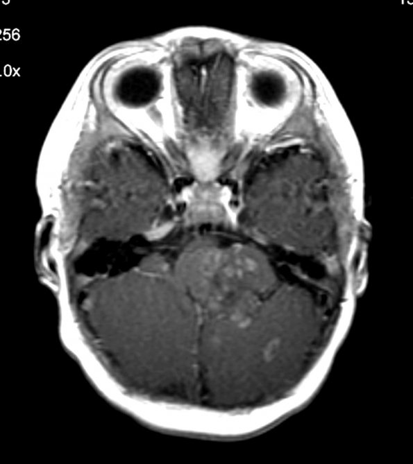 1A3 Medulloblastoma, extensively nodular (Case 1) MRI 4 - Copy