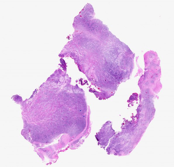 1B1 Medulloblastoma, nodular (Case 1) 1 H&E 1