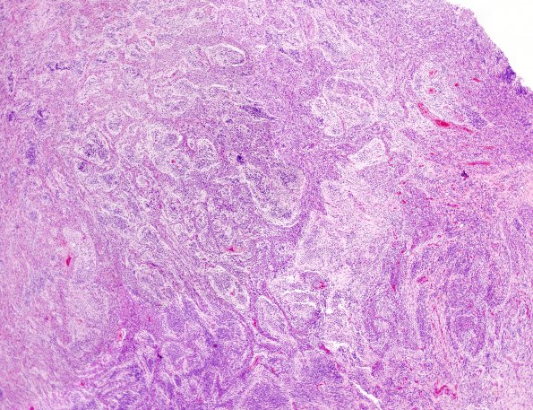 1B2 Medulloblastoma, nodular (Case 1) H&E 5