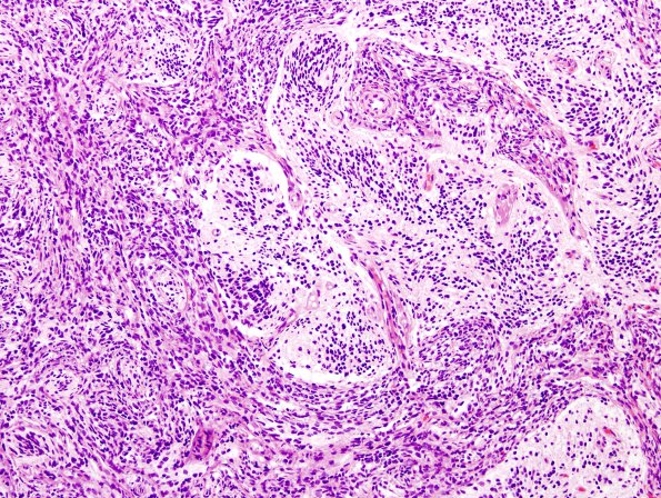 1B3 Medulloblastoma, nodular (Case 1) H&E 4