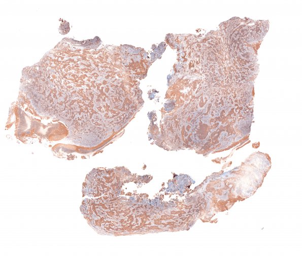 1C1 Medulloblastoma, nodular (Case 1) 1 SYN 1