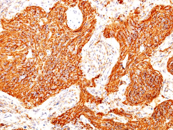 1C3 Medulloblastoma, nodular (Case 1) SYN 2