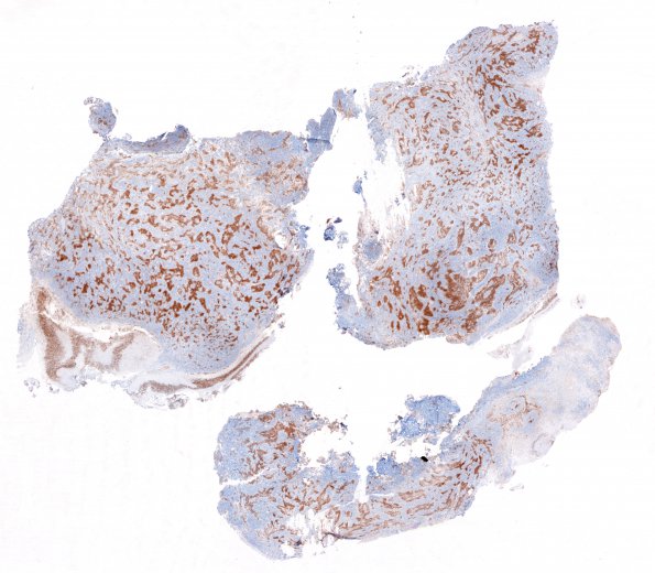 1D1 Medulloblastoma, nodular (Case 1) 1 NeuN 1