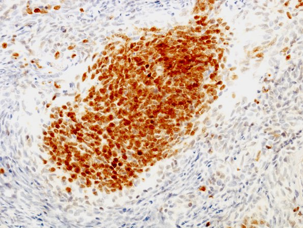 1D3 Medulloblastoma, nodular (Case 1) NeuN 2