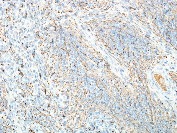 1E2 Medulloblastoma, nodular (Case 1) GFAP 2.jpg