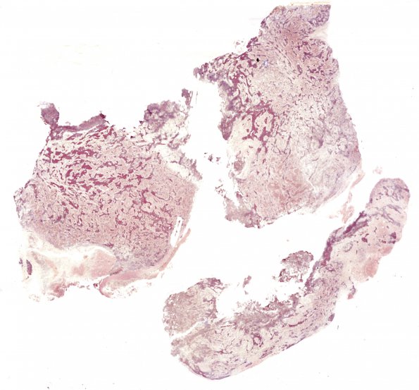 1F1 Medulloblastoma, nodular (Case 1) 1 Retic 1