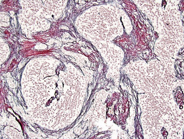 1F2 Medulloblastoma, nodular (Case 1) Retic 2.jpg