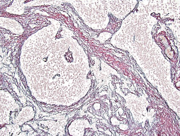 1F3 Medulloblastoma, nodular (Case 1) Retic 3.jpg