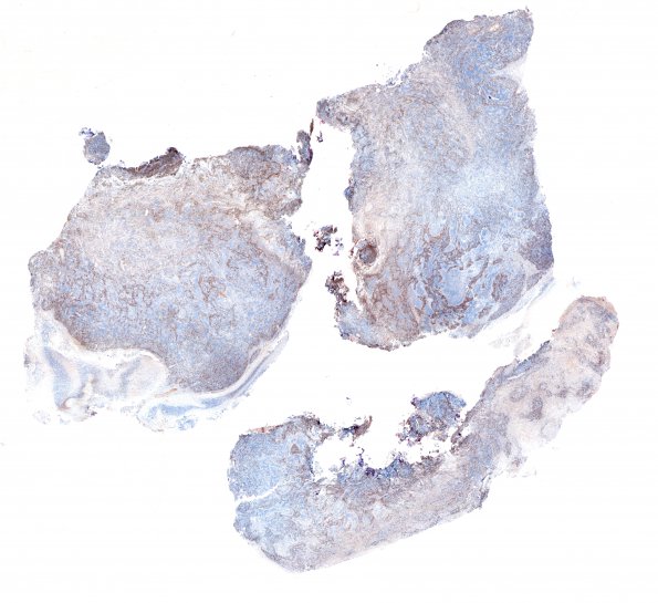 1G1 Medulloblastoma, nodular (Case 1) 1 MIB 1