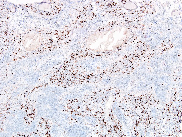 1G2 Medulloblastoma, nodular (Case 1) 10X MIB choice a