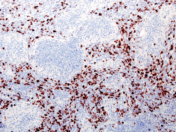 1G3 Medulloblastoma, nodular (Case 1) MIB 3A