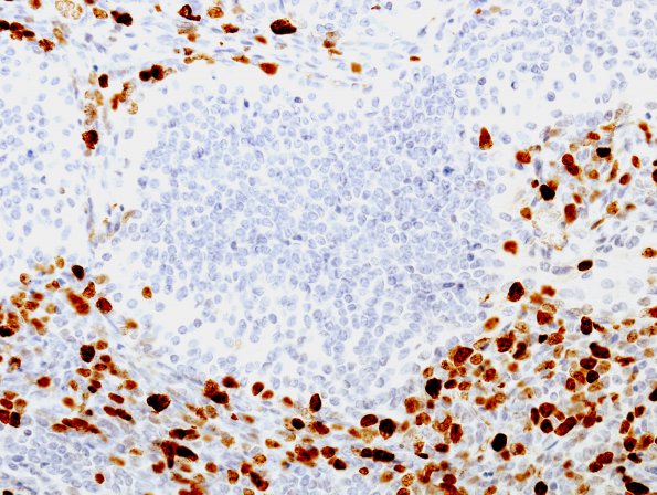 1G4 Medulloblastoma, nodular (Case 1) MIB 2