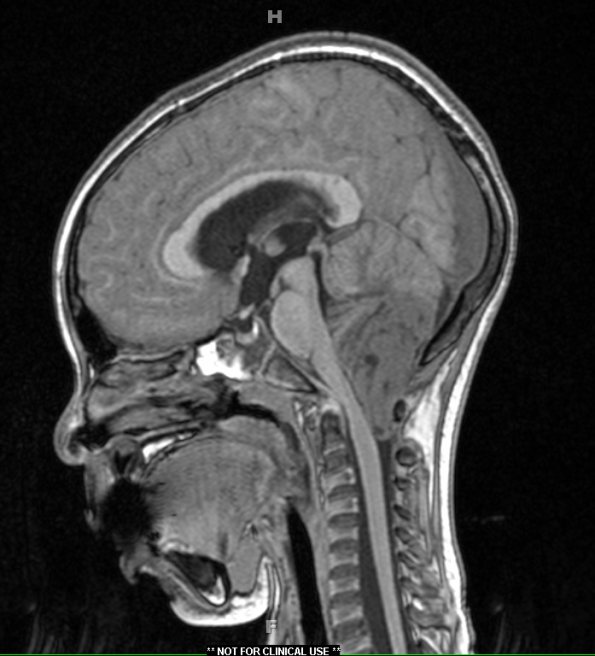 2A1 Medulloblastoma, focal nodularity (Case 2) T1 1 - Copy