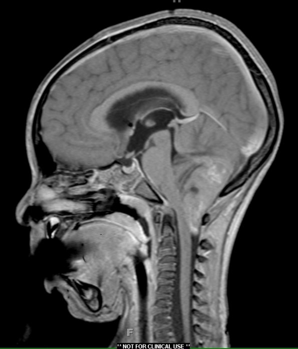 2A2 Medulloblastoma, focal nodularity (Case 2) T1 W3 - Copy