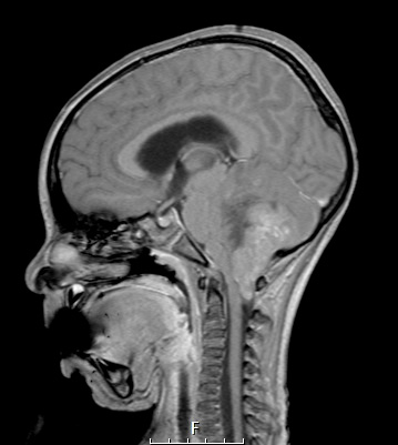 2A3 Medulloblastoma, focal nodularity (Case 2) T1W - Copy