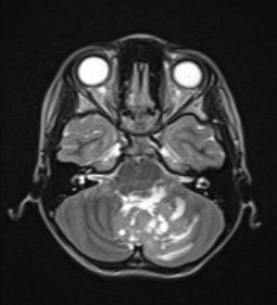 2A4 Medulloblastoma, focal nodularity (Case 2) T2A - Copy