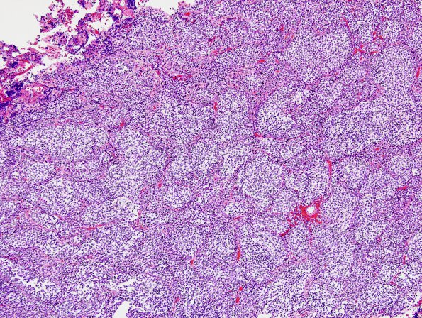 2B1 Medulloblastoma, focal nodularity (Case 2) H&E 2.jpg