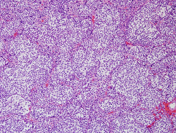 2B2 Medulloblastoma, focal nodularity (Case 2) H&E 1.jpg