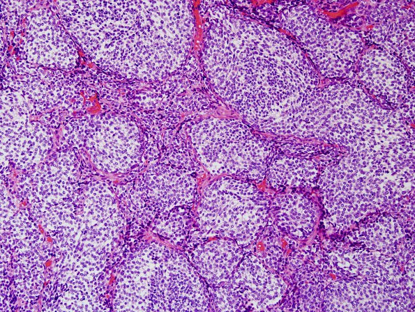 2B3 Medulloblastoma, focal nodularity (Case 2) H&E 8.jpg