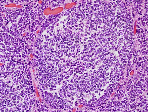 2B4 Medulloblastoma, focal nodularity (Case 2) H&E 5.jpg