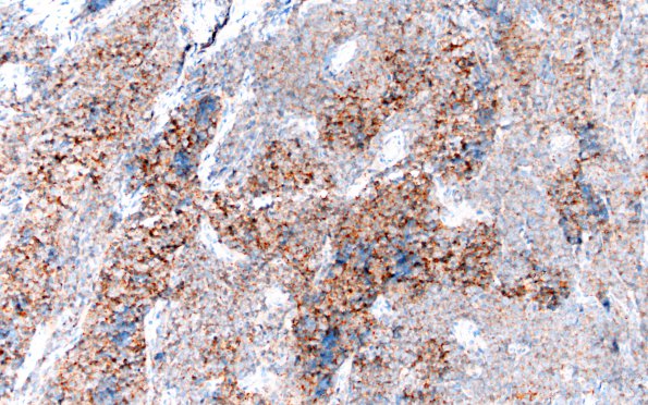 2C1 Medulloblastoma, focal nodularity (Case 2) SYN 20X