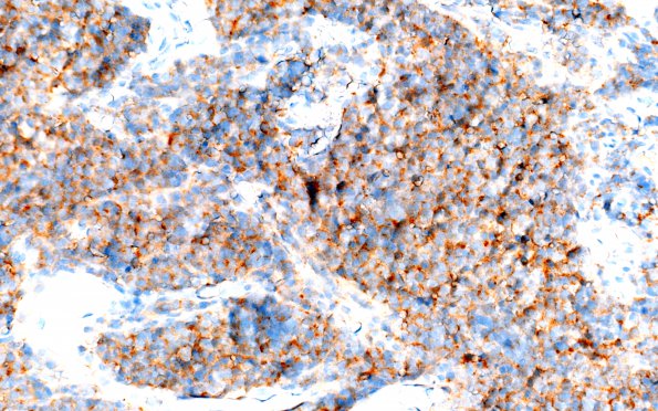 2C2 Medulloblastoma, focal nodularity (Case 2) SYN 40X 2