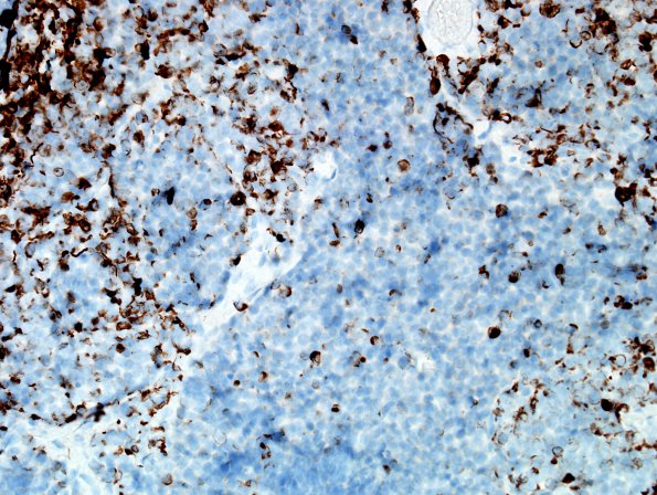 2D Medulloblastoma, focal nodularity (Case 2) GFAP 1.jpg