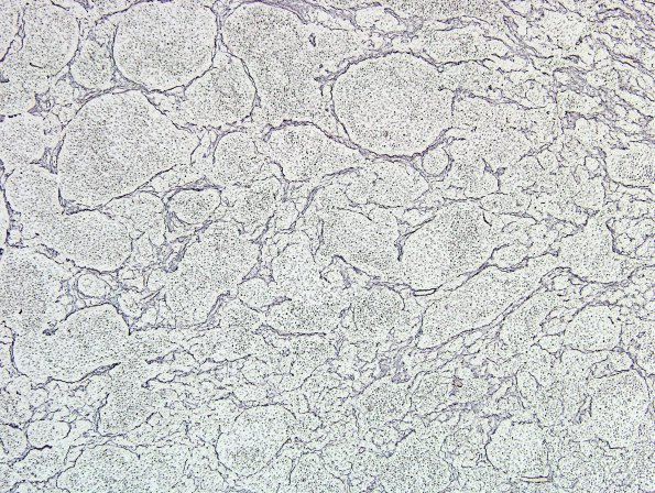 2E2 Medulloblastoma, focal nodularity (Case 2) area A 10X Retic