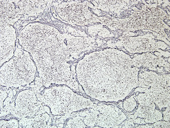 2E3 Medulloblastoma, focal nodularity (Case 2) Retic 1.jpg