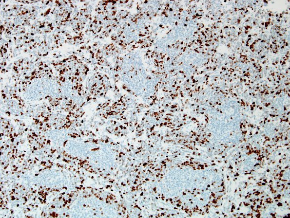 2F1 Medulloblastoma, focal nodularity (Case 2) Ki67 1.jpg