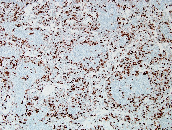 2F2 Medulloblastoma, focal nodularity (Case 2) Ki67 3.jpg