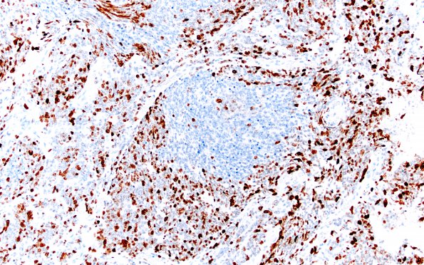 2F3 Medulloblastoma, focal nodularity (Case 2) Ki67 20X 2