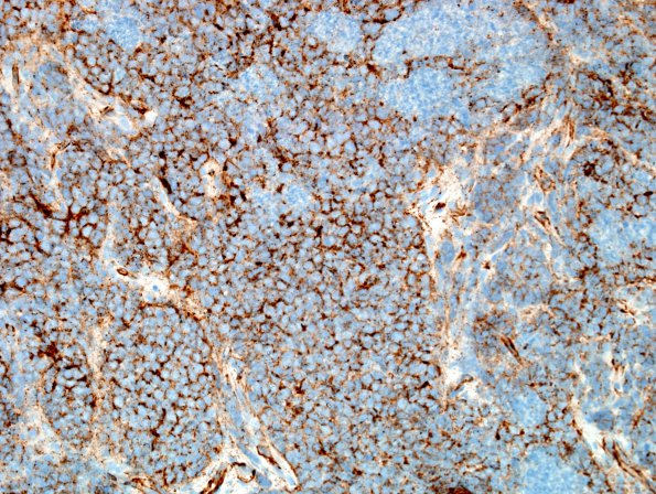 2G1 Medulloblastoma, focal nodularity (Case 2) b-catenin 2.jpg