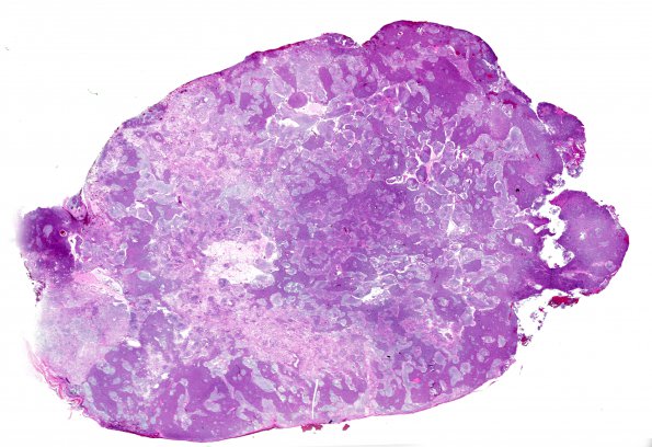 3A1 Medulloblastoma (Case 3) 1 H&E 1