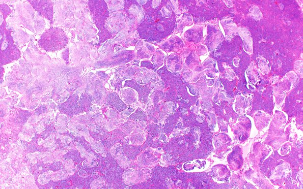 3A2 Medulloblastoma (Case 3) H&E 2X