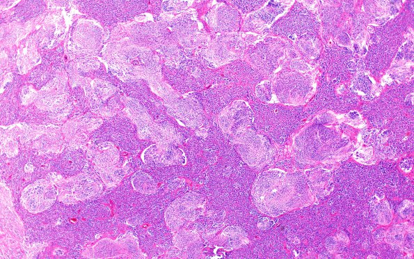 3A3 Medulloblastoma (Case 3) H&E 4X