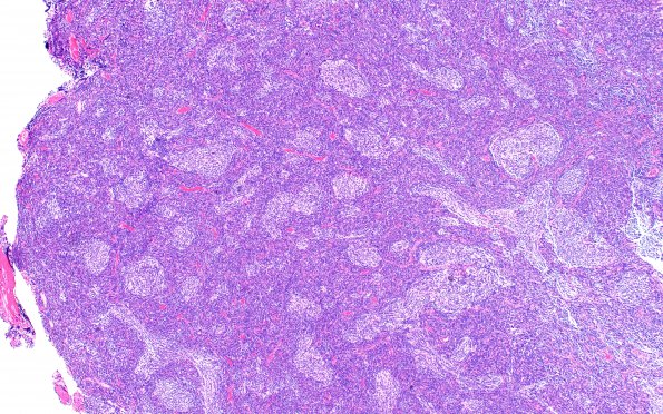 3A4 Medulloblastoma, desmoplastic (Case 3) H&E 4X