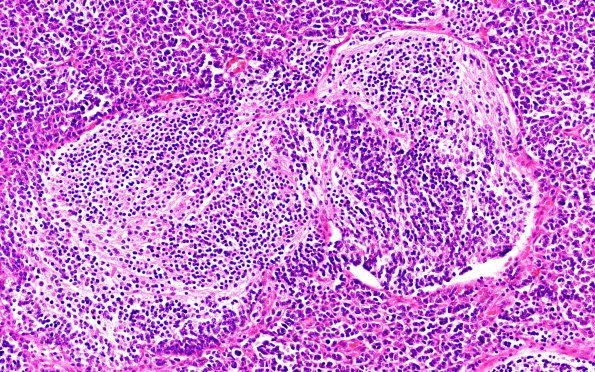 3A5 Medulloblastoma (Case 3) H&E 20X