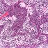 3A6 Medulloblastoma, desmoplastic (Case 3) a