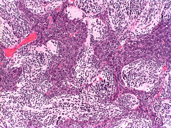 3A6 Medulloblastoma, desmoplastic (Case 3) a