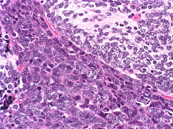 3A7 Medulloblastoma, desmoplastic (Case 3) c