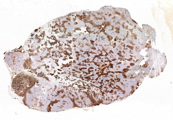 3B1 Medulloblastoma (Case 3) Syn 3 (2)