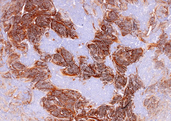 3B2 Medulloblastoma, desmoplastic (Case 3) SYN 4X