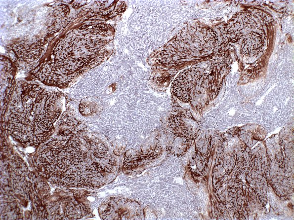 3B3 Medulloblastoma, desmoplastic (Case 3) syn