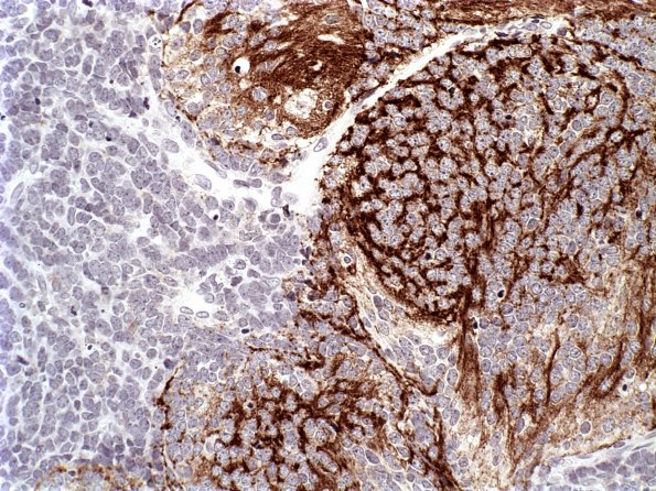 3B4 Medulloblastoma, desmoplastic (Case 3) SYN 1